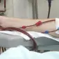 Dr. Manoj Arora providing hemodialysis treatment to a kidney patient at Max Hospital, Delhi