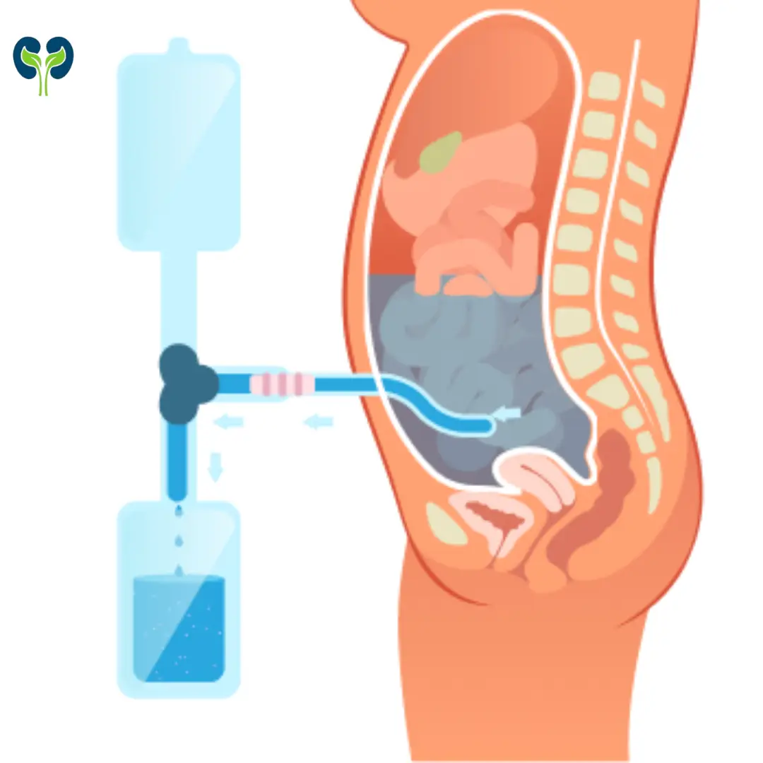 Illustration of peritoneal dialysis treatment showing fluid exchange process and medical team assisting the patient.nephrologist, Dr. Manoj Arora."